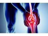 BÀI TẬP ĐIỀU TRỊ HIỆU QUẢ THOÁI HÓA, VIÊM KHỚP GỐI